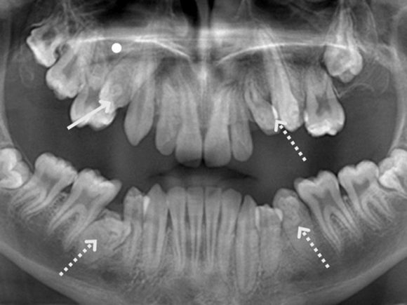 Osteogenesis Imperfecta (OI) and Dentistry